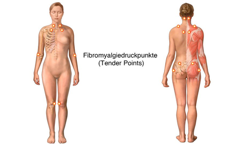 Fibromyalgiedruckpunkte Tender Points. Bei Fibromyalgie kommt es begleitend zu zahlreichen Beschwerden. Dazu gehören unter anderem Schlafstörungen, Müdigkeit, Morgensteifigkeit, Zittern und Depressionen.