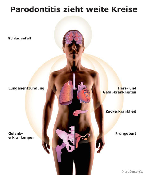 Die möglichen Folgen einer Parodontose für die Gesundheit. (© proDente e.V.)