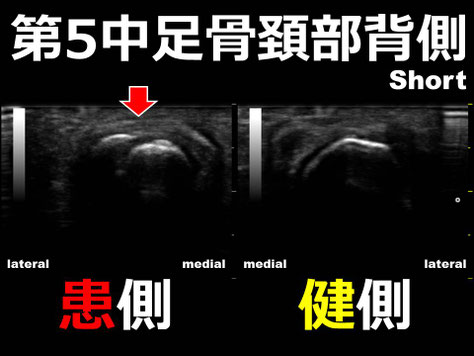豊田市　おおつか接骨院　第５中足骨頚部骨折　超音波画像
