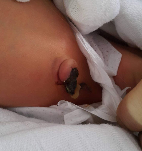 This baby's umbilical cord was tied with a latex ring. 