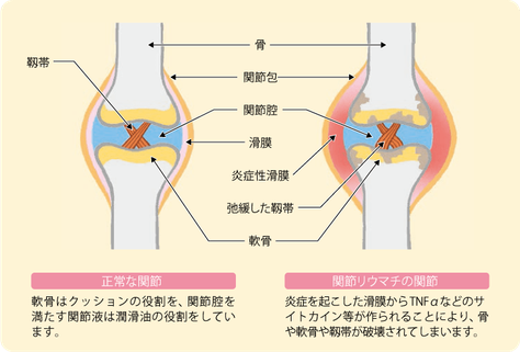 関節リウマチの関節