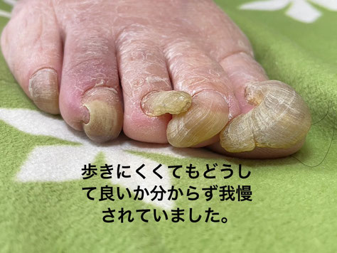 肥厚しきれなくなり伸びすぎて傷を作った爪