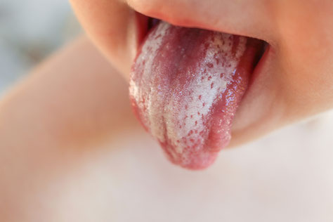 鵞口瘡,舌,斑点
