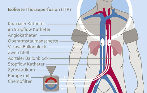 Schematische Darstellung der isolierten Thoraxperfusion (ITP): Menschlicher Oberkörper mit markierten Blutgefäßen, Kathetern, Staumanschetten und externer Pumpe mit Chemofilter.