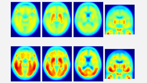 TEP montrant des dépôts de protéine Tau dans le cerveau de personnes en bonne santé (en haut) et ceux avec Alzheimer (en bas). Les zones rouges indiquent les dépôts de tau