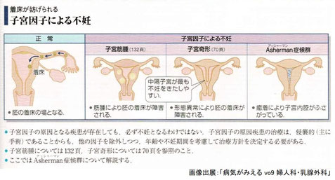 着床が妨げられる