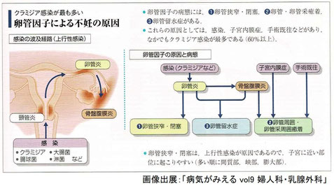 卵管因子による不妊の原因