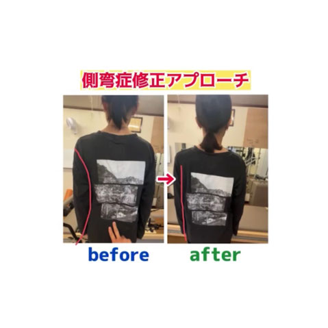側弯症改善アプローチのビフォーアフターの画像