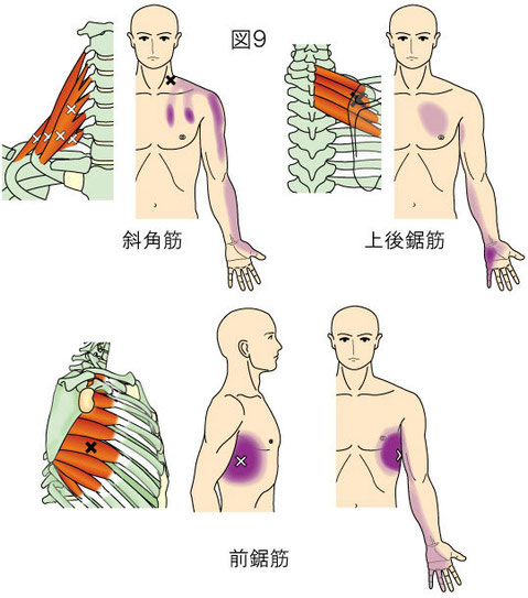 斜角筋・上後鋸筋・前鋸筋トリガーポイントによる痛み