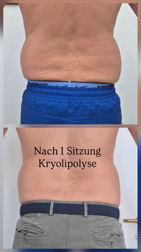 Kryolipolyse basel Stadt bei beauty basel solutions