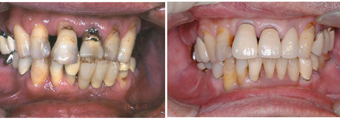 禁煙支援と歯周病治療、その後に虫歯の治療をした患者さんです。