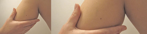 Lymphdrainage