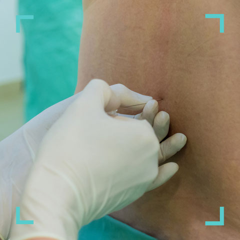 Ärztin führt Lumbalpunktion am unteren Rücken eines Patienten in der neurologischen Praxis Neuro im Zentrum St. Gallen durch