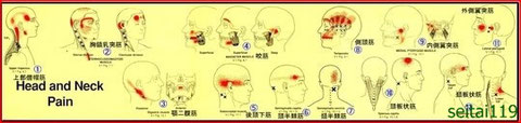 首の痛みトリガーポイント