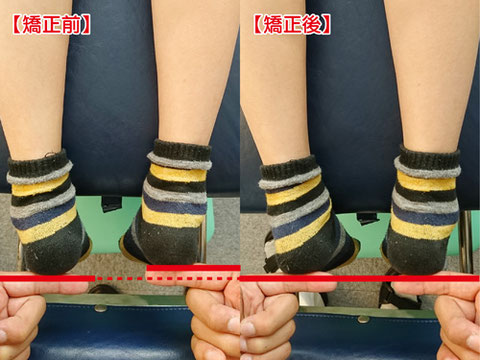 矯正前、骨盤のねじれによって右足が短いのが確認できます。 矯正後は、左右の足の長さが綺麗に揃いました。