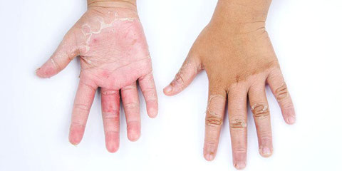 Foto de las dos manos de un niño con psoriasis
