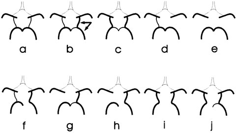 variations in Circle of Willis