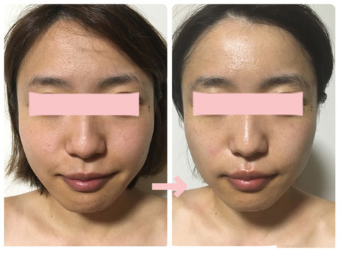多治見の肌改善専門エステサロンでビューティークラフトメソッドの美の職人技フェイシャルでくすみ・毛穴改善をした症例