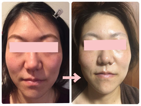 多治見の肌改善専門エステサロンでビューティークラフトメソッドの美の職人技フェイシャルでニキビ・赤み改善をした症例