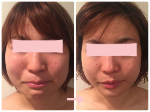 多治見の肌改善専門エステサロンでビューティークラフトメソッドの美の職人技フェイシャルで小顔改善をした症例