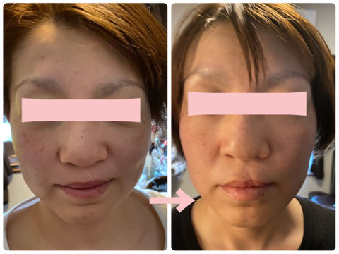多治見の肌改善専門エステサロンでビューティークラフトメソッドの美の職人技フェイシャルでたるみ改善をした症例