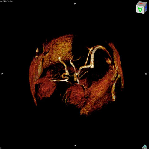 脳血管3D画像