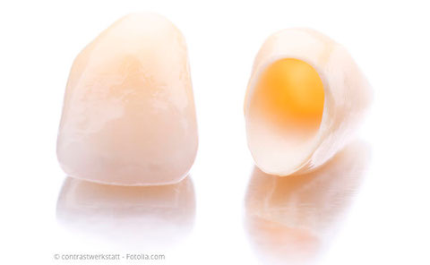 Zahnkronen aus reiner Keramik: Ästhetisch und gut körperverträglich