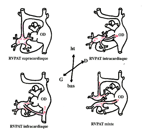 Vue postérieure du coeur: Exemple des différents types de RVPAT