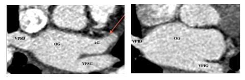 Aspect en scanner de l'auricule gauche, avec abouchement des VP,déterminant une oreillette morphologiquement gauche
