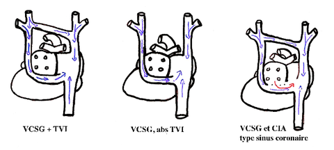 Vue postérieure du coeur: exemples de différents types de VCS double