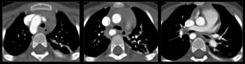 Exemple de crosse aortique droite en coupe axiale de scanner