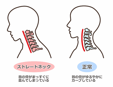 ストレートネック説明図