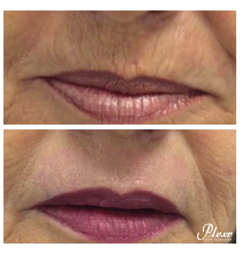 Cómo eliminar las arrugas en el labio superior con Plexr
