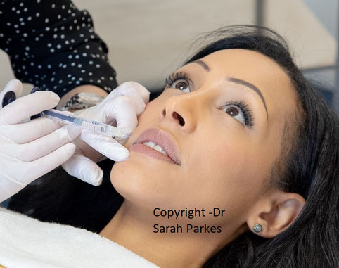 lip filler expert, lip fillers, lip fillers neath