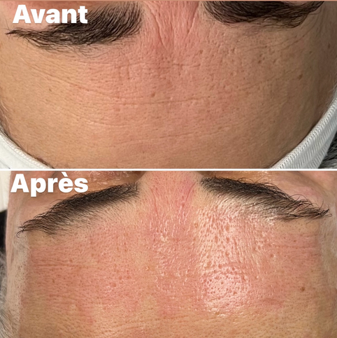 Avant/Après 1 séance microneedlind front: pore resserrés, peau plus lisse et lumineuse, rides estompées. Effet glow