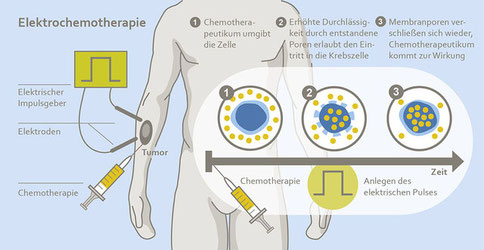 Schematische Darstellung der Elektrochemotherapie: Behandlung eines Tumors am Arm mit Chemotherapie und elektrischem Impuls, erläutert durch eine Abfolge von Zellprozessen.
