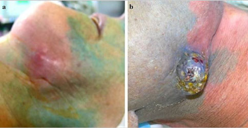 Zwei Bilder: a) Zeigt eine durch Strahlentherapie verursachte Bindegewebsfribrose ohne blaue Verfärbung, b) Zeigt eine blau verfärbte Hautstelle nach Strahlentherapie im Kopf-Hals-Bereich.