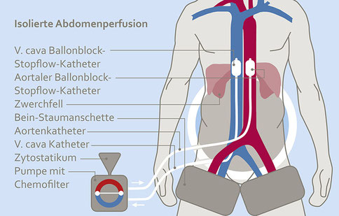 Schematische Darstellung der isolierten Abdomenperfusion: Menschlicher Oberkörper mit markierten Blutgefäßen, Kathetern und externer Pumpe mit Chemofilter.