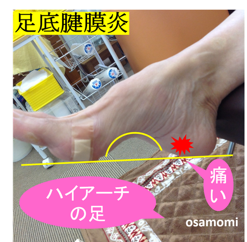 オサモミ整体院 足底腱膜炎 ハイアーチ