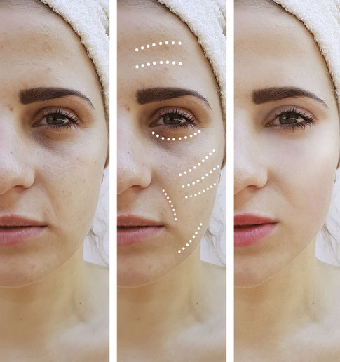 Biopeeling X Microneedling Behandlung