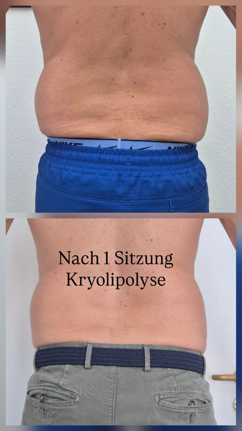 kryolipolyse Bauch und Flanken in Basel