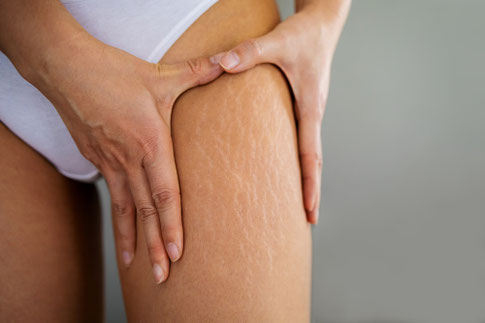 Cellulites Behandlung