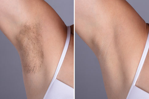 Haare waxing machen lassen in Basel