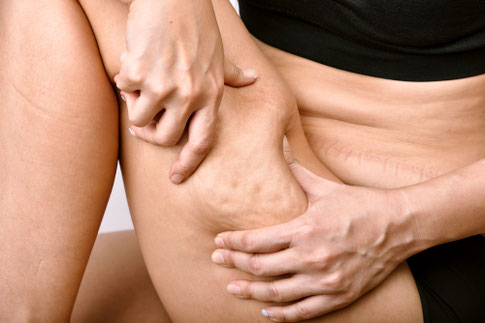 cellulites behandlung Basel