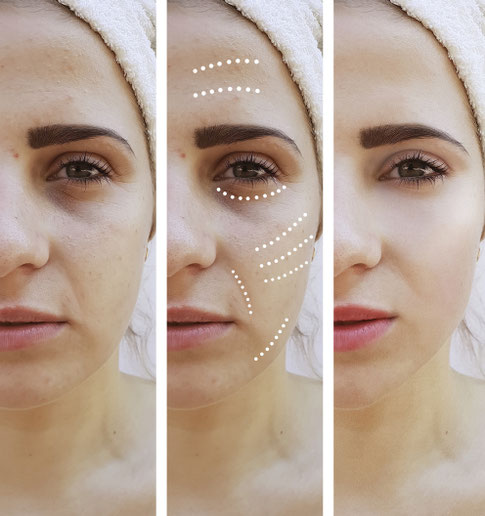 Biopeeling Microneedling Basel