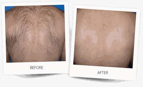 Soprano Ice Platinum HydraFacial Dauerhafte Haarentfernung Kempten Lasern Diodenlaser