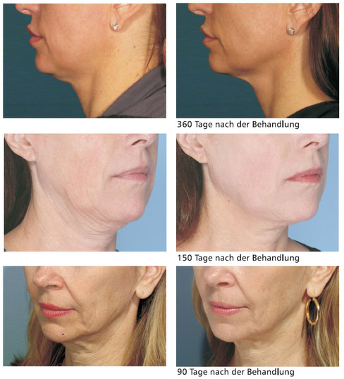 HIFU - Hautstraffung ohne OP - Institut für Körperästhetik