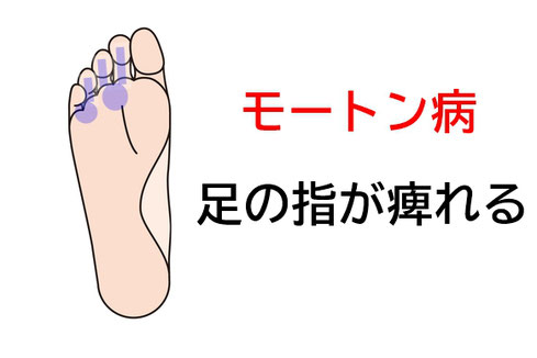 足底 足裏 の痛み 公式 鍼灸院 鶴 札幌市東区