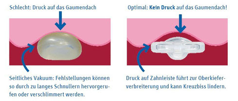 Welchen Einfluss der Schnuller auf die Form der Kiefer hat. (© Curaden Swiss GmbH)