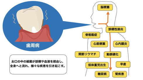 歯周病と全身疾患